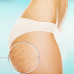 Estrias nos glúteos