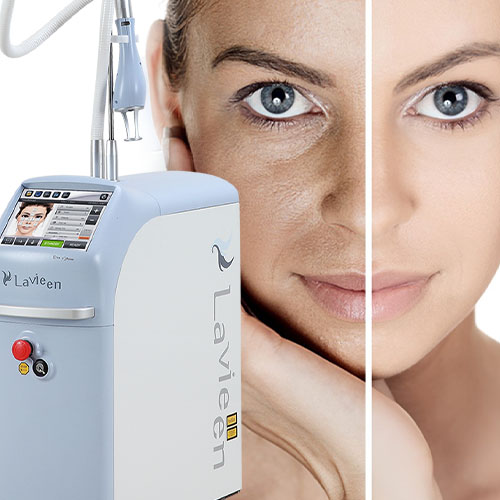 BB Laser Lavieen