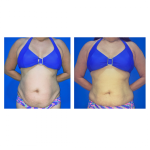 antes e depois gordura localizada